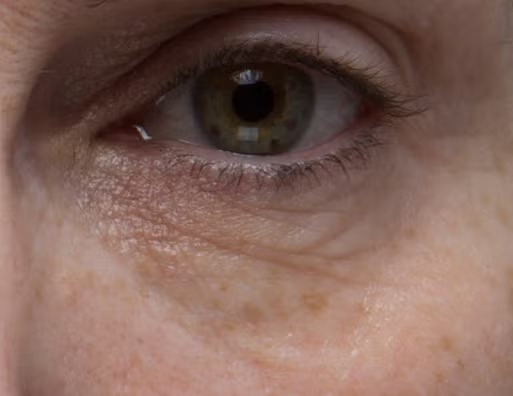 Peptide4 Eye Recovery Cream 2 Weeks After